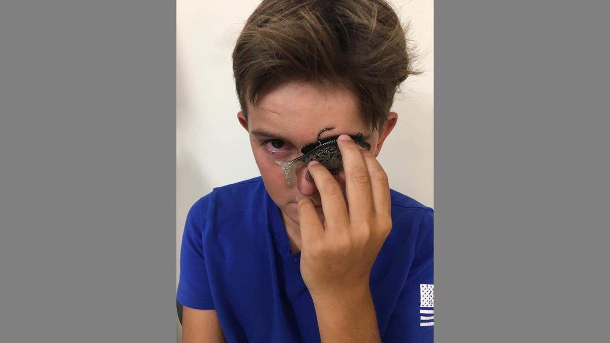 A Summerville, South Carolina, boy hooked a bass, but the fish let go and he ended up with the hook in his face.