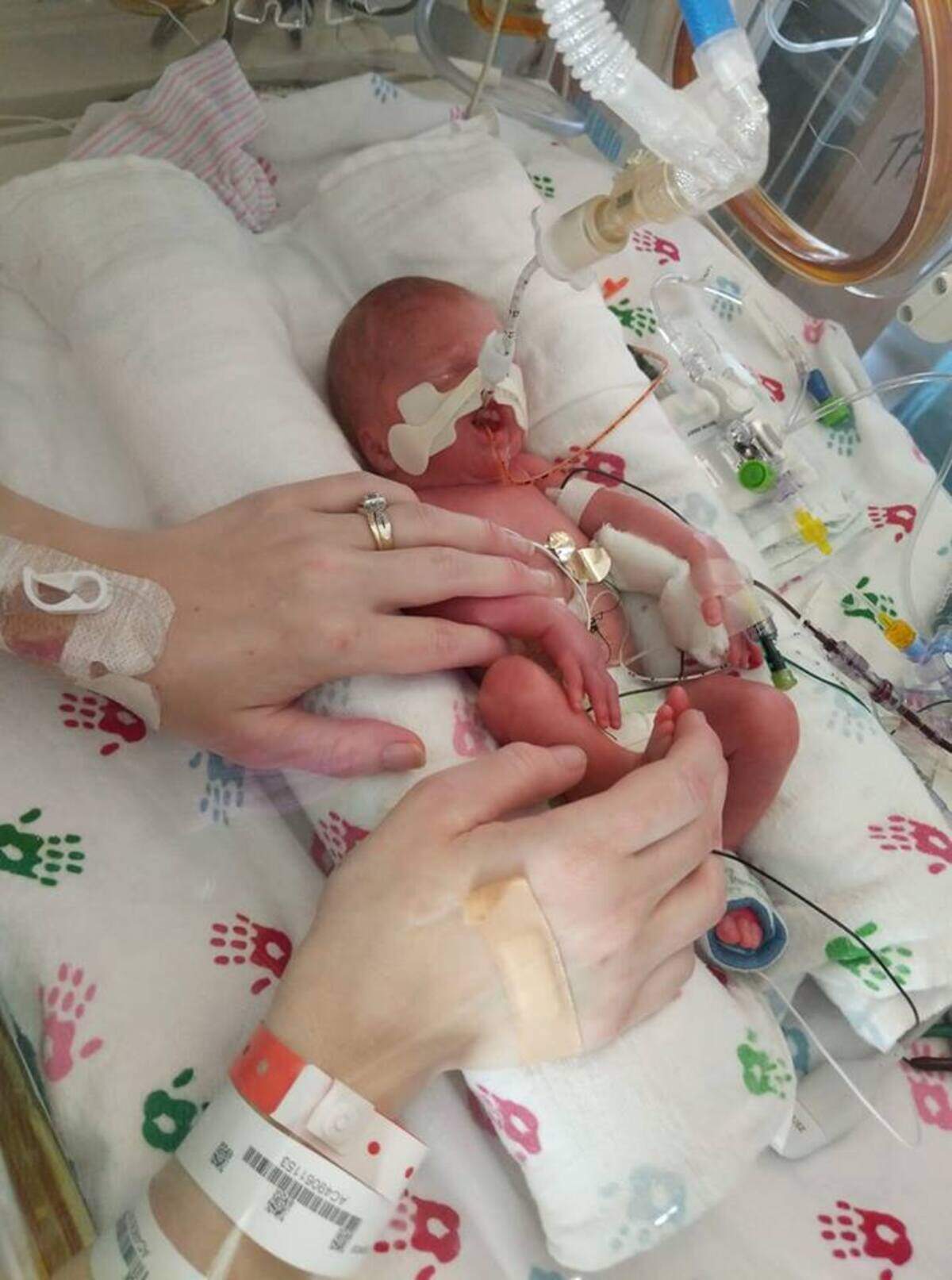 An early photo of baby Treyton, who was born 12 weeks early and weighed less than three pounds.