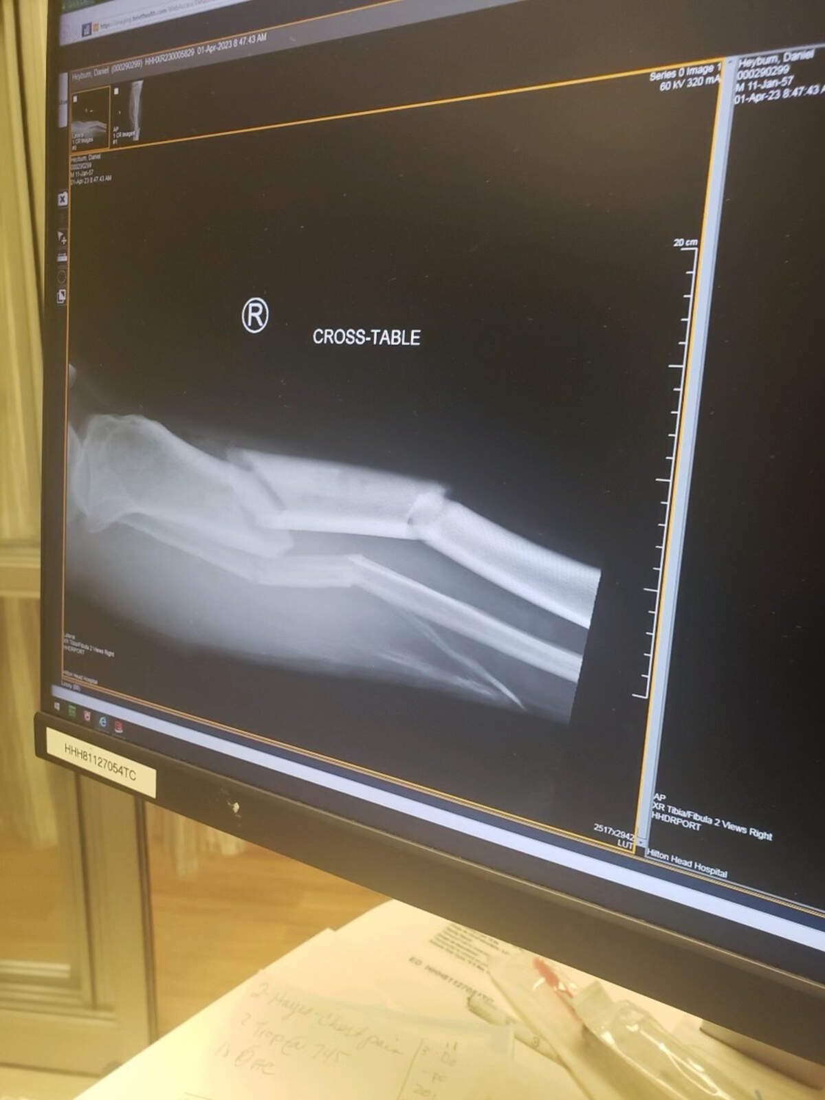 An X-ray shows the damage to Daniel Heyburn’s right leg after police say Tysha Shailayah Brown ran over him on April 1, 2023, at a Burger King restaurant on Hilton Head Island.
