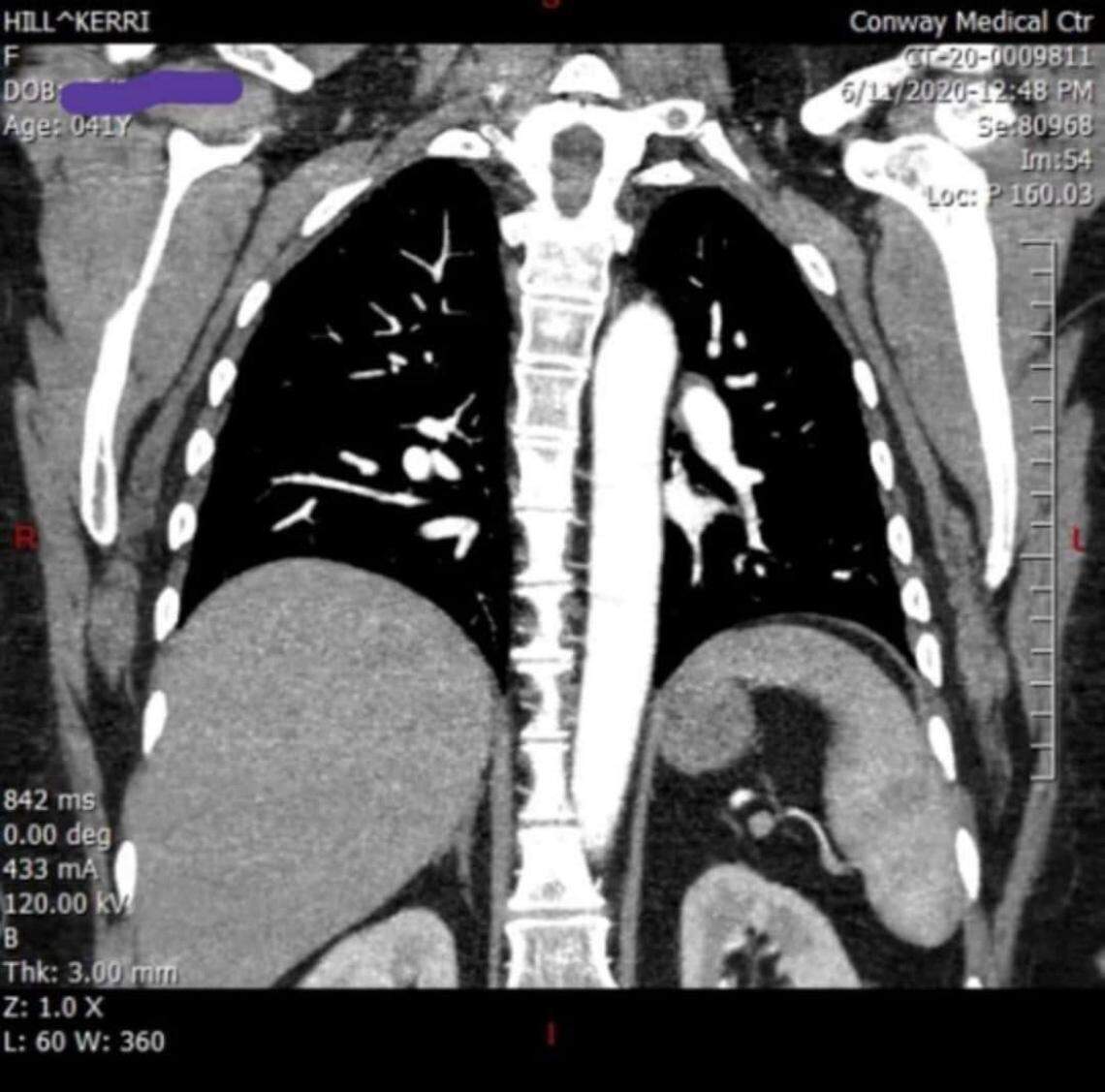 Kerri Hill, 41, of Galivants Ferry, South Carolina, suffered lung damage due to COVID-19, she said. Hill contracted SARS-CoV-2 in late March, more than 180 days ago.