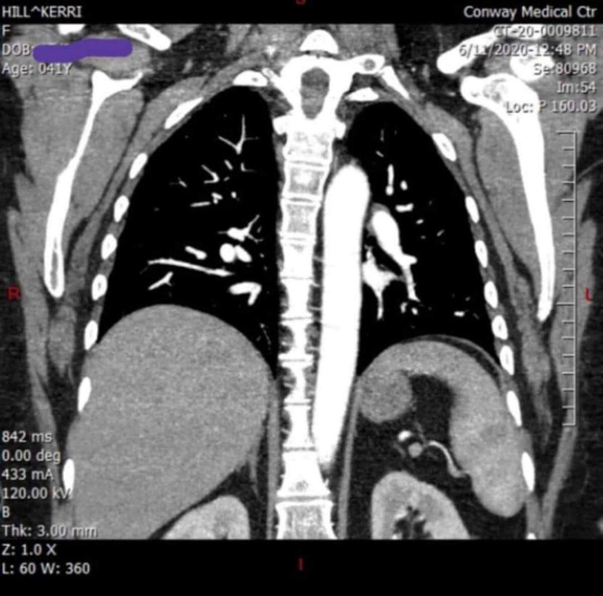 Kerri Hill, 41, of Galivants Ferry, South Carolina, suffered lung damage due to COVID-19, she said. Hill contracted SARS-CoV-2 in late March, more than 180 days ago.