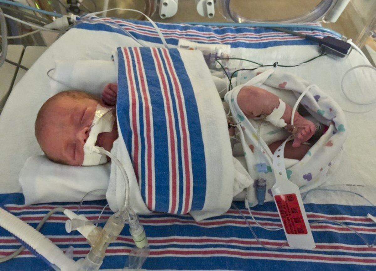 Baby Oliver Kuczka has slowly needed less and less help breathing, his dad Jacob Kuczka said.