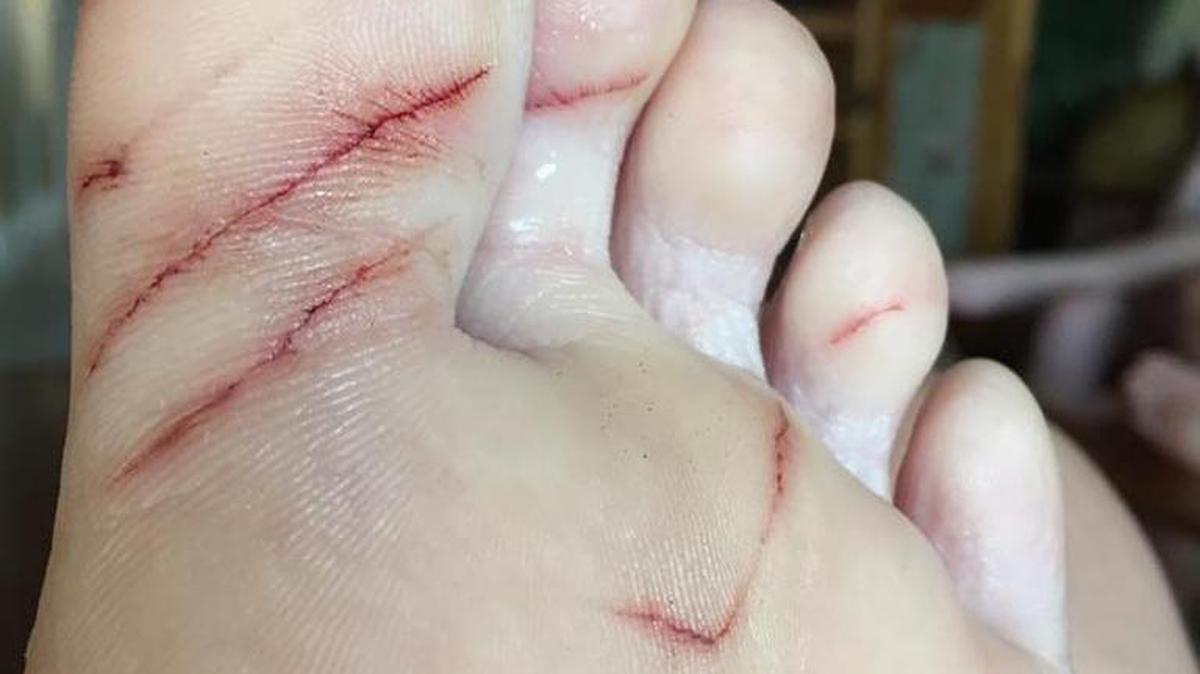 Linten Suttle’s foot bears the marks of a shark’s teeth.