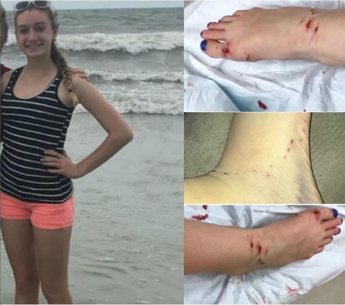 Olivia Wallhauser, of Jasper, Indiana, said she was bitten by a shark while swimming off South Forest Beach. The photos on the left show her wounds from the attack.